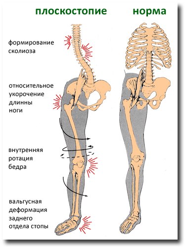 Причина болей в тазобедренном суставе